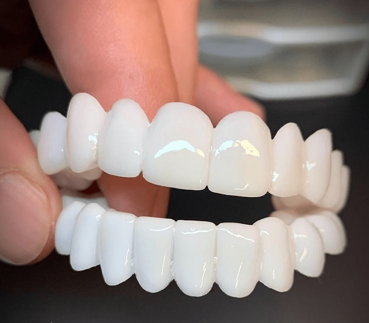 Dental veneers made from flexible, high-quality resin, designed for a natural appearance and comfortable wear, ideal for enhancing smiles. 0