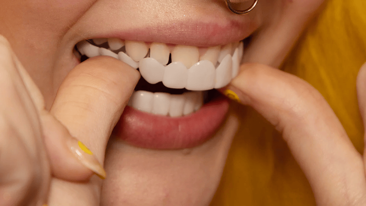 Snap-On Veneers for an Instant Smile Enhancement featuring a Natural Look, made from Comfortable Fit Medical-Grade Polypropylene for a seamless appearance. 6